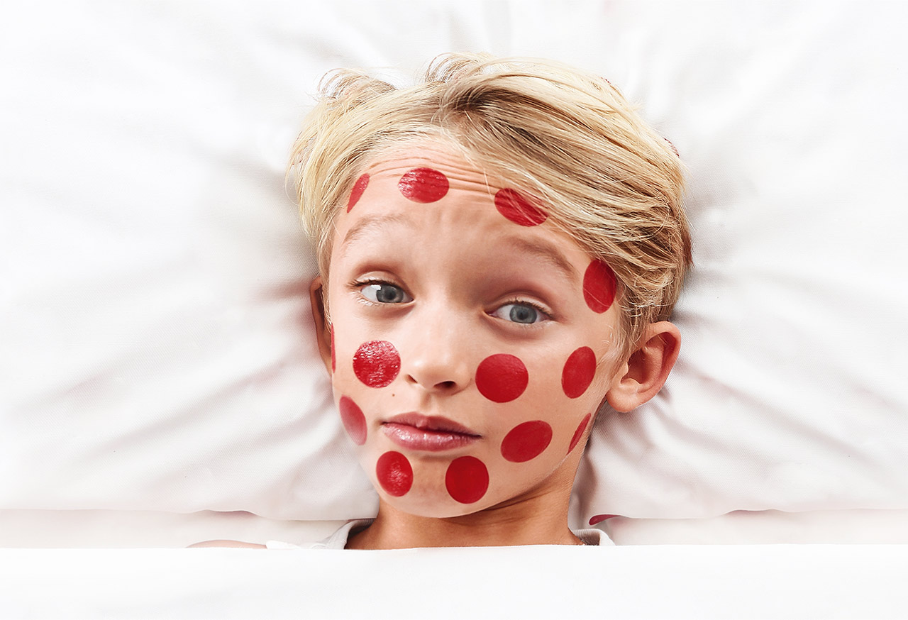 Ein Junge liegt stirnrunzelnd mit großen, aufgemalten roten Punkten im Bett