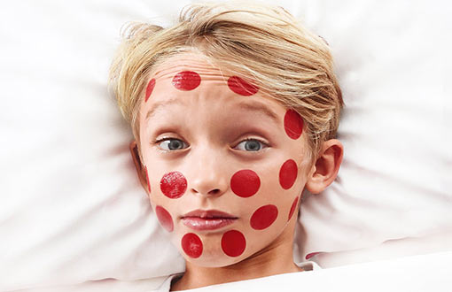 Ein Junge liegt stirnrunzelnd mit großen, aufgemalten roten Punkten im Bett